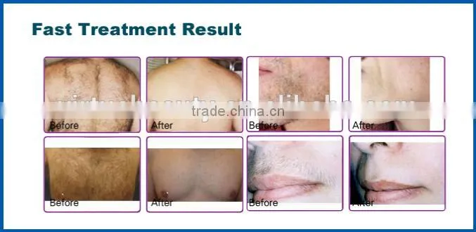 CE approved 755nm laser Alexandrite hair removal machine
