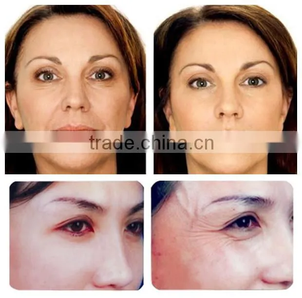 HOT!Portable Fractional RF Microneedle with Stretch Marks
