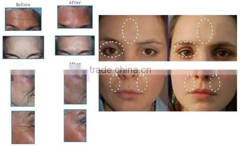 New RF skin rejuvenation cavitation body slimming machine