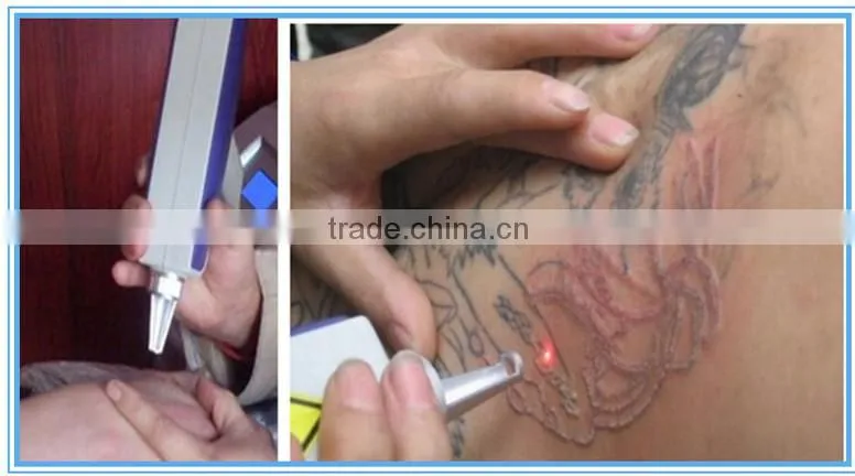 stable performance nd yag laser tattoo removal machine