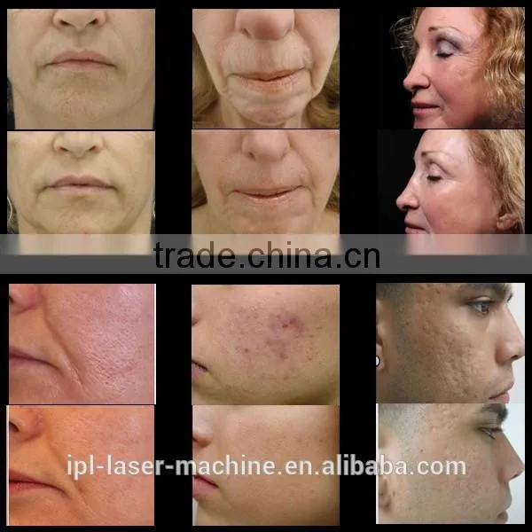 best China manufacturer factory direct sale price! portable microneedle fractional rf nubway