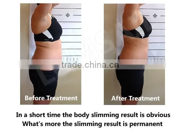 Mini skin freeze belt /portable mini cryotherapy fat freeze machine/cellulite therapy machine for home use