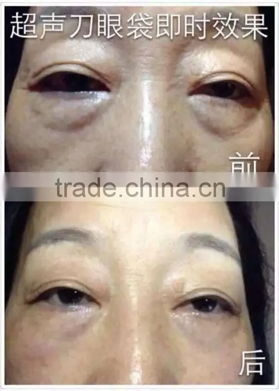 Portable smart 3D anti wrinkle treatment HIFU beauty machine
