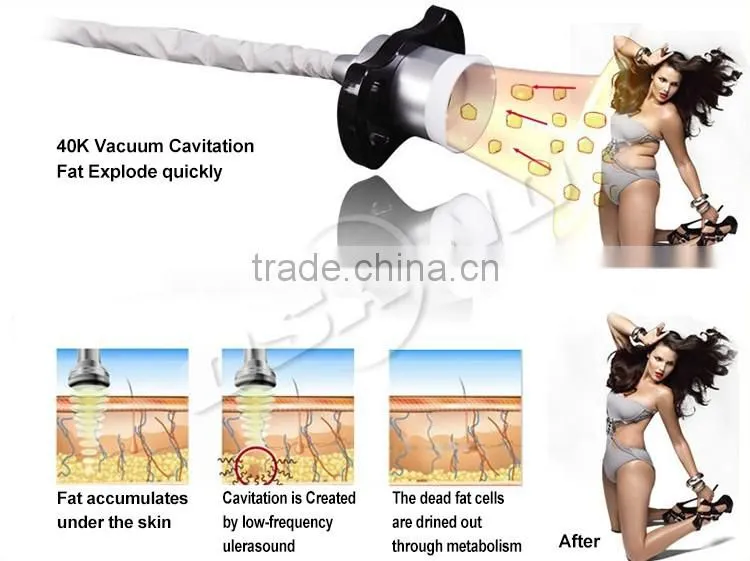 Hot Sale Cryotherapy Vacuum Criolipolisis machine radiofrequence