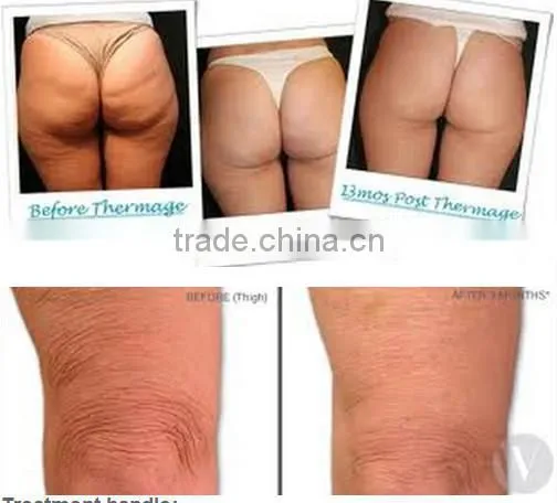 RF Fractional skin rejuvenation beauty equipment salon beauty machine
