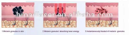 1064nm laser tattoo removal machine fda approved laser alexandrite laser hair removal machine