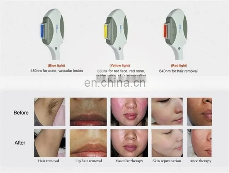 Ipl Hair Removal Laser Ipl Mini Laser Hair Removal Machine Ipl Hair Removal Painless At Home