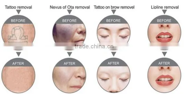 Portable q switched nd yag laser hair and tattoo removal machine low price