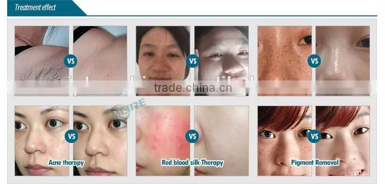 Professional e light ipl hair removal reviews
