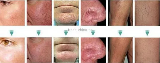 Hottest in the market!!!! super 30mhz Ultra high freqeuncy spider vein removal