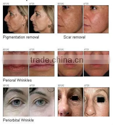 high quality Factory price fractional erbium laser 2940