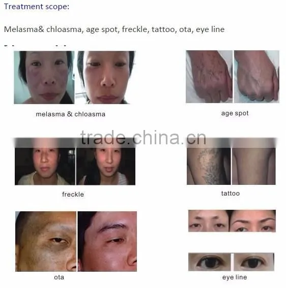 2016 Newest Tattoo laser q-switch ND:Yag laser tattoo removal machine with best price