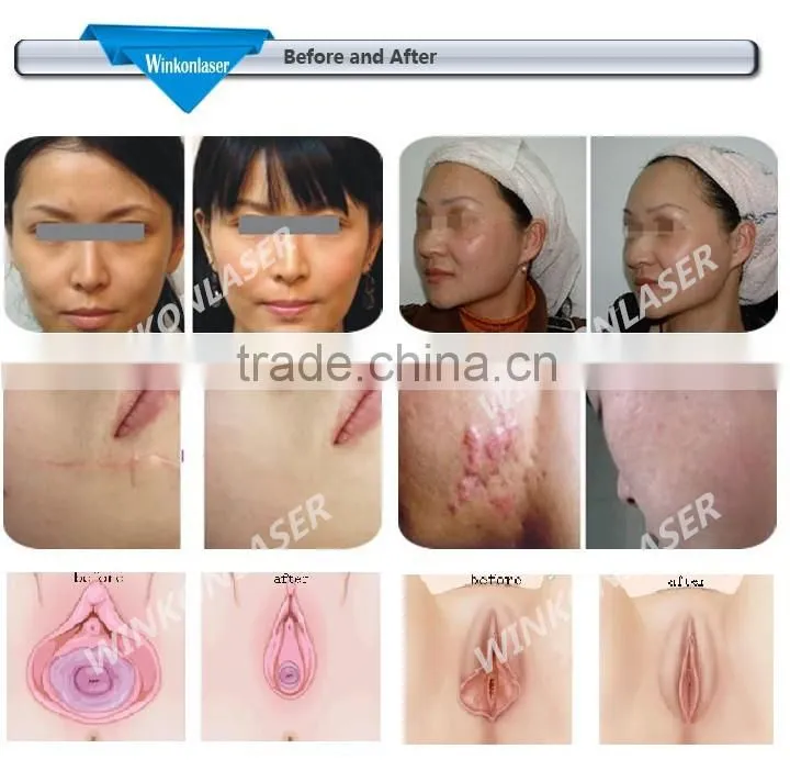 Factory price! Professional doctor use CO2 vaginal laser not only vaginal lifting but also face lift