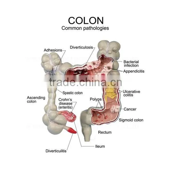 Pathology Colon Model Organs Human Body Anatomy