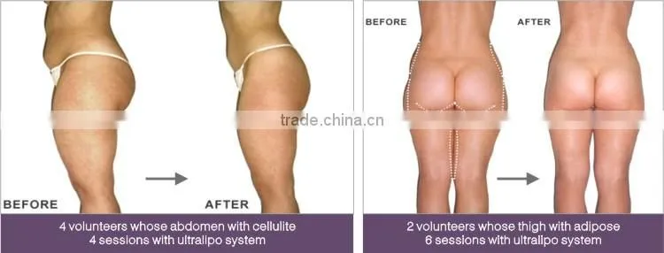 sonic wave fat belly burning machine cavitation rf beauty salon equipment