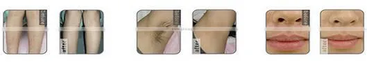 China manufacturer promotion Effective Portable fda approved laser hair removal machine home use from japan