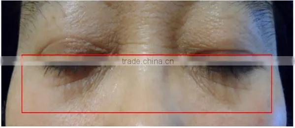 Hot!!! New products,portable home hifu anti-wrinkle machine /hifu machine home