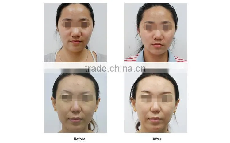Fashionable appearance Home use face slimming machine/facial beauty equipment
