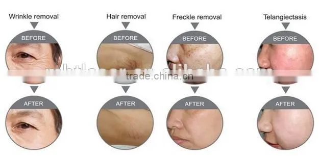 2016 New Hottest!!! Brighter shopping Through hole shr opt ipl shr hair removal machine with GOST-P