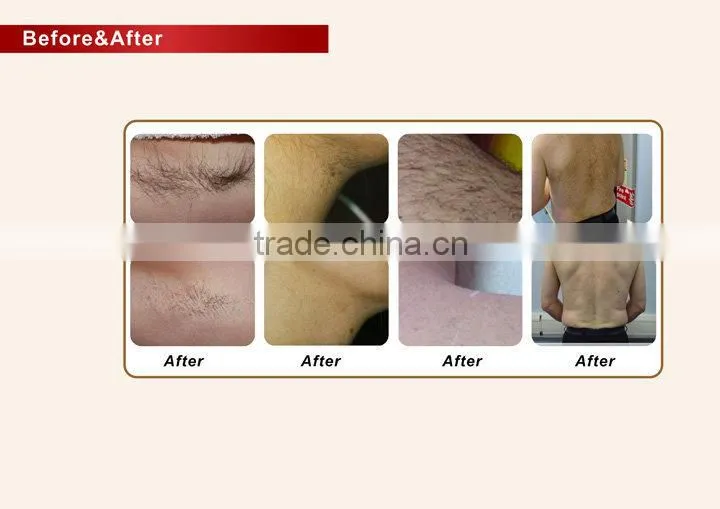 Laser diode 808nm diode laser hair removal machine -DIDOIII