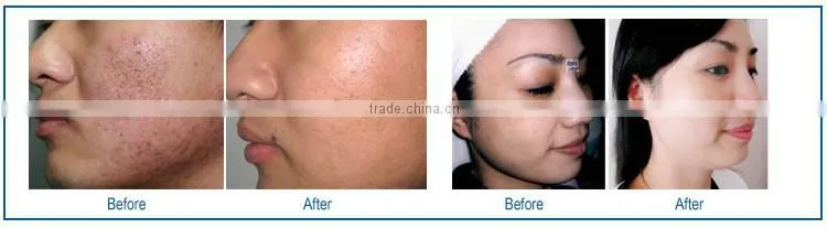 High quality co2 laser vaginal rejuvenation treatment