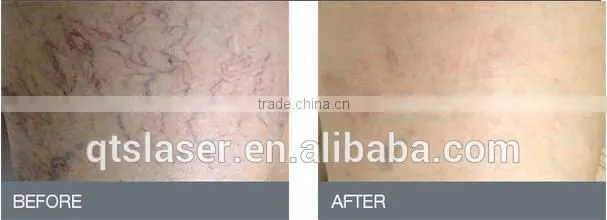 2016 new 980nm diode laser for vascular removal blood vessels removal/anti-redness remover/skin care
