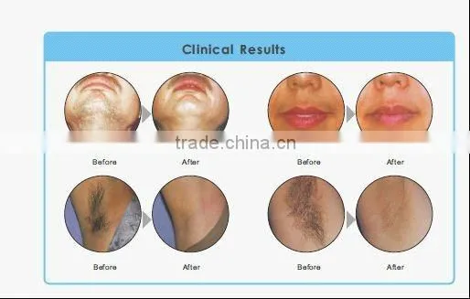 Super elight machine epilation skin renewing