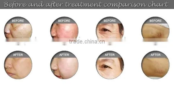 Bottom price hottest sale design device hot CE approved device for hair removal home ipl device