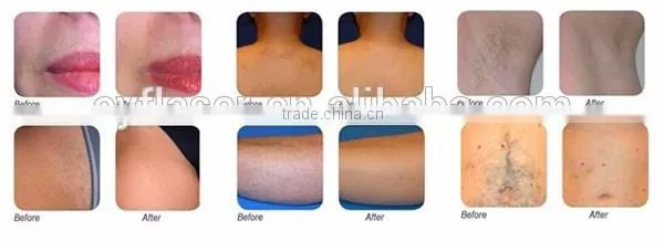 2016 Professional laser hair removal /808 nm diode laser hair removal price