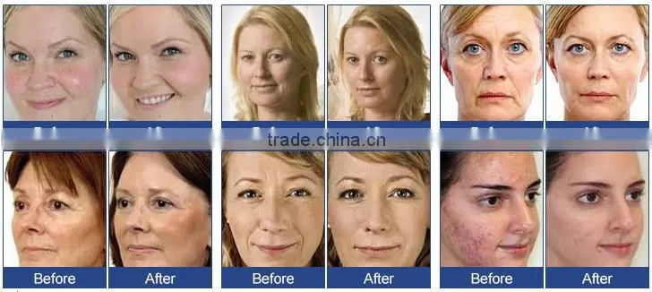 The latest model 2016 pore cleaning injection oxygen jet machine with skin detection