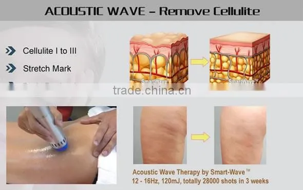 shockwaves machine for Cellulite removal/Loose skin get tightened/Connective tissue /Body Reshaping and slimming