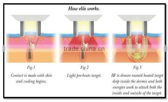 Top selling!! portable laser ipl hair reduction with RF (CE/ISO) SE3100