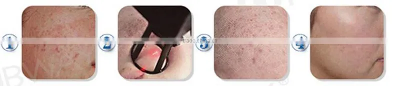 2016 best-selling fractional laser co2 skin resurfacing / scar removal treatment high power co2 laser cutting machine
