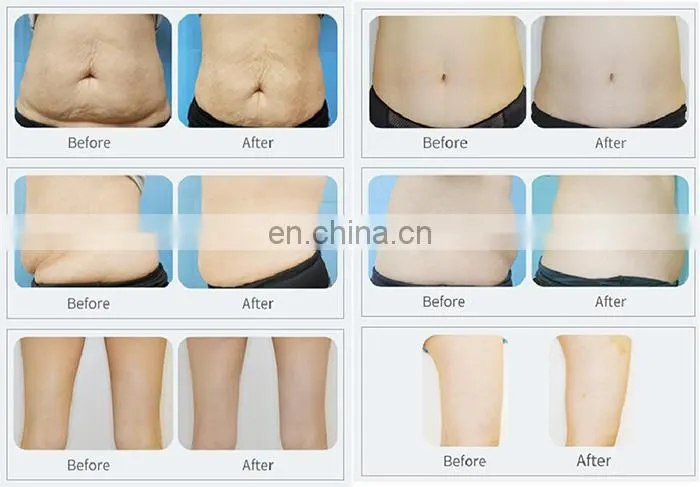 Home Use Fat Freezing Cool Body Sculpting Cryotherapy Machine for Sale