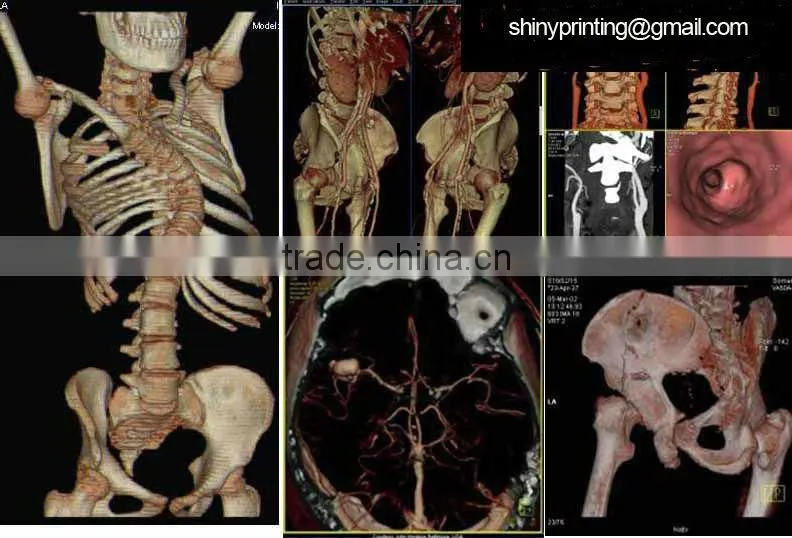 high tech laser printer medical dry film
