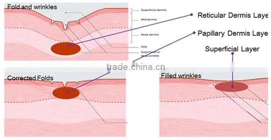 Top performance!!!! microneedle skin treatment portable fractional rf