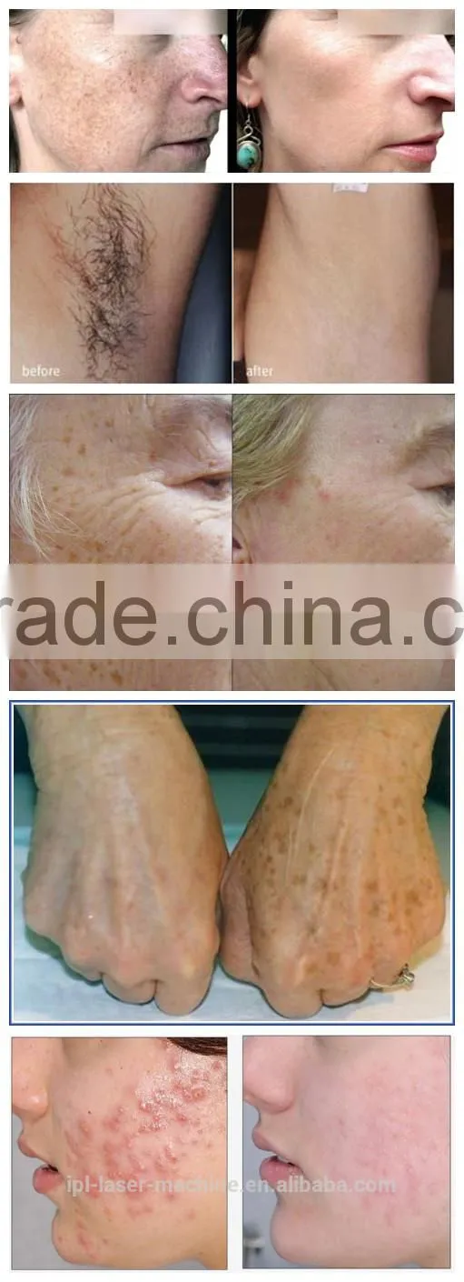 TOP SALES!! NUBWAY new design good quality 3 handles ipl machine with ce certificate