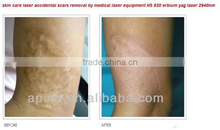 2940nm Er yag fractional laser scar removal machine HS-820