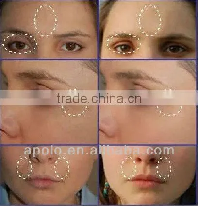 RF skin care equipment portable beauty salon equipment HS 530 by shanghai med apolo medical technology