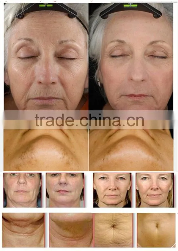 2015 America Skin Tighten Radiofrequency Equipment with 4 heads