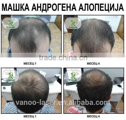 High quality hair regrowth lasers / fulfix hair regrowth