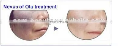 beauty studio nd yag laser tattoo removal treatment head machine D006