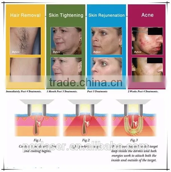 Beauty spa use best professional IPL machine for hair removal