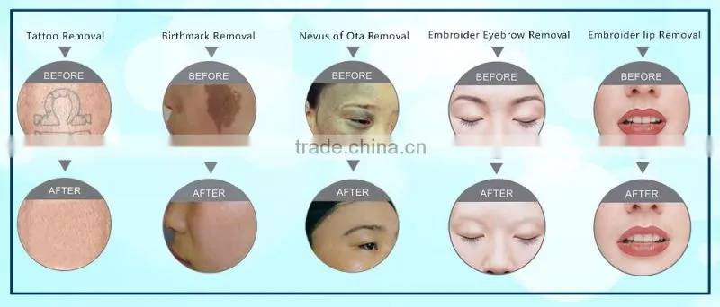F12 2016 Good quality most popular birthmark and fast tattoo removal laser price laser tattoo removal
