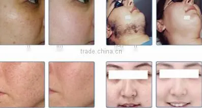 Manufacturer laser hair removal machine For home use
