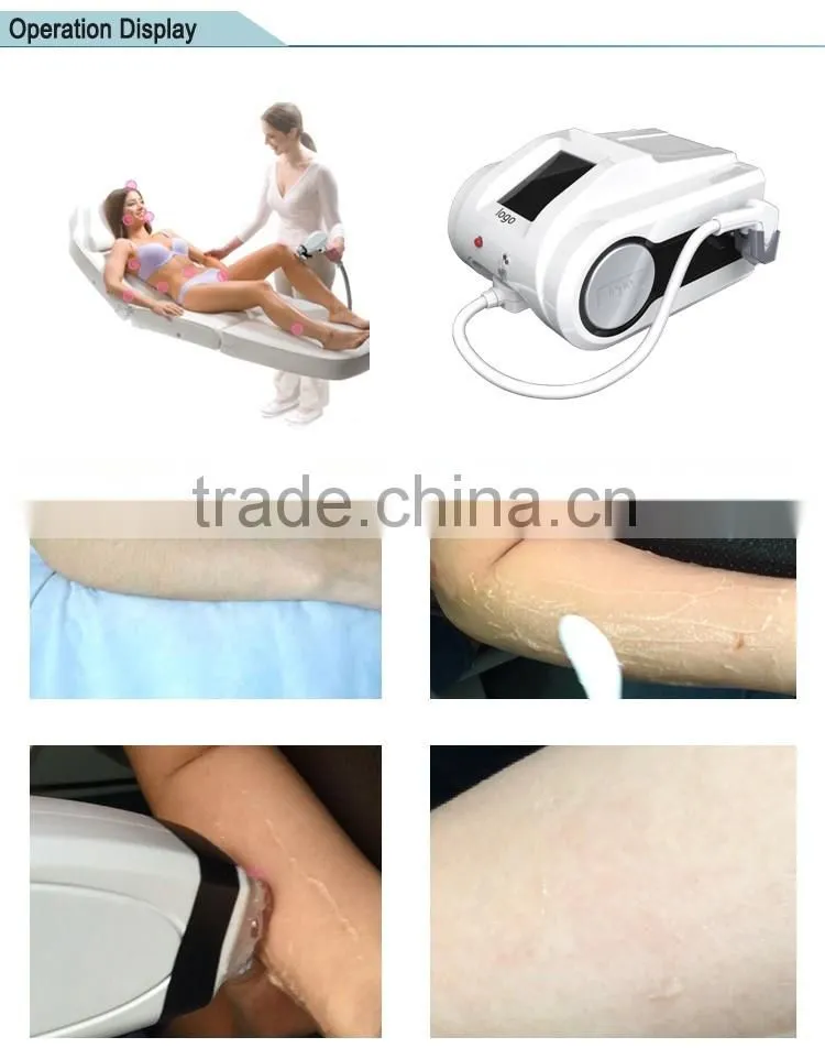 810 lumenis lightsheer duet laser for sale