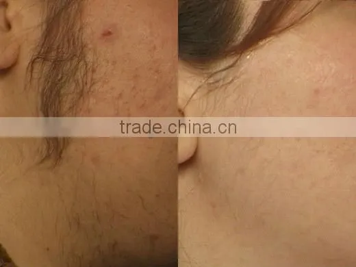 Cooling system 1mm-12mm laser depilation for hair removal,nail fungus laser --P001