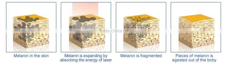 rejuvi tattoo removal q switch nd yag carbon laser