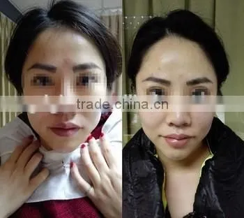 2016Mini HIFU Machine/ Home Use HIFU Machine/Portable HIFU machine