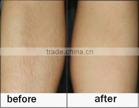 12*12mm2 big light spot 808 nm Diode Laser Hair Removal Machine